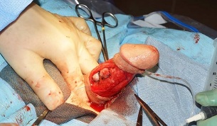 operacija povećanja penisa