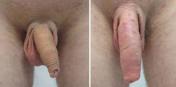 Penis prije i poslije vješanja utega